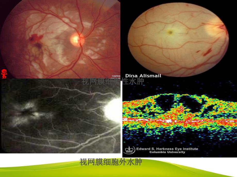视网膜血管疾病_第4页