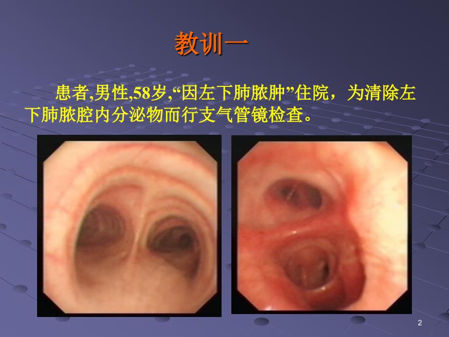 （推荐医学）支气管镜诊疗相关大咯血的预防与救治_第2页