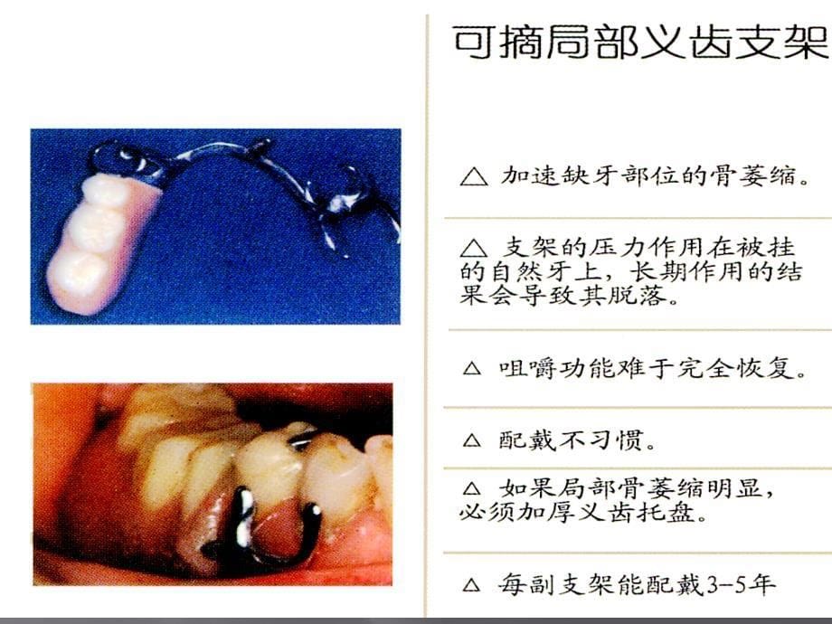 种植牙介绍ppt课件_第5页