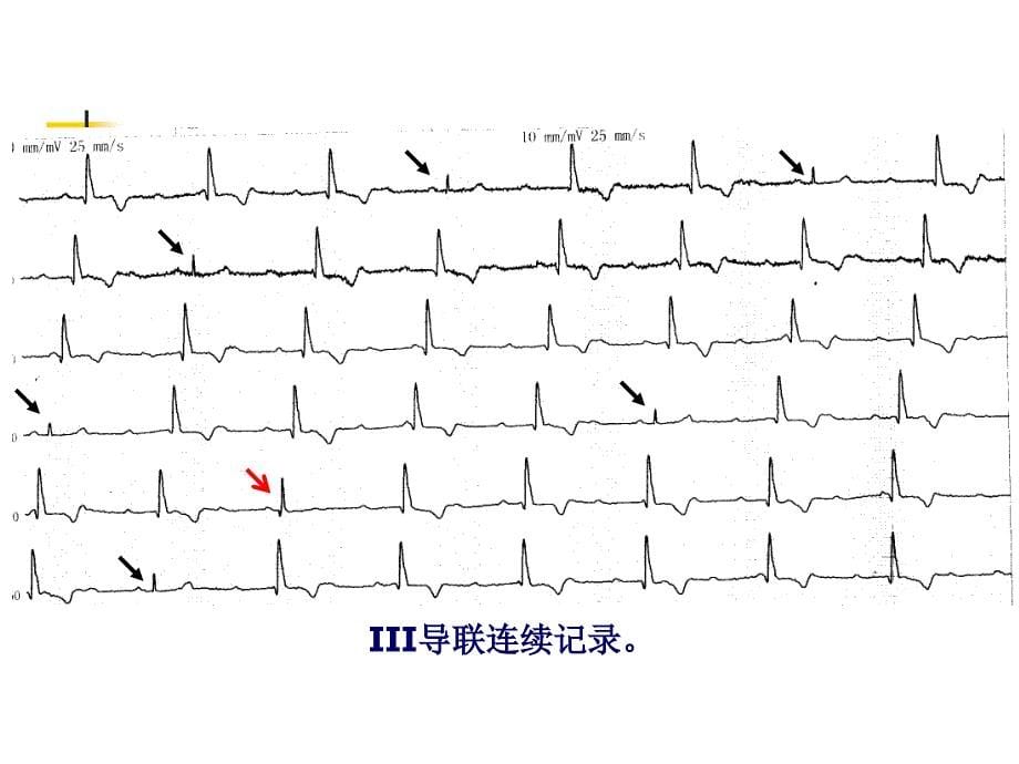 高度AVB植入双腔起搏器术后VCM运作_第5页