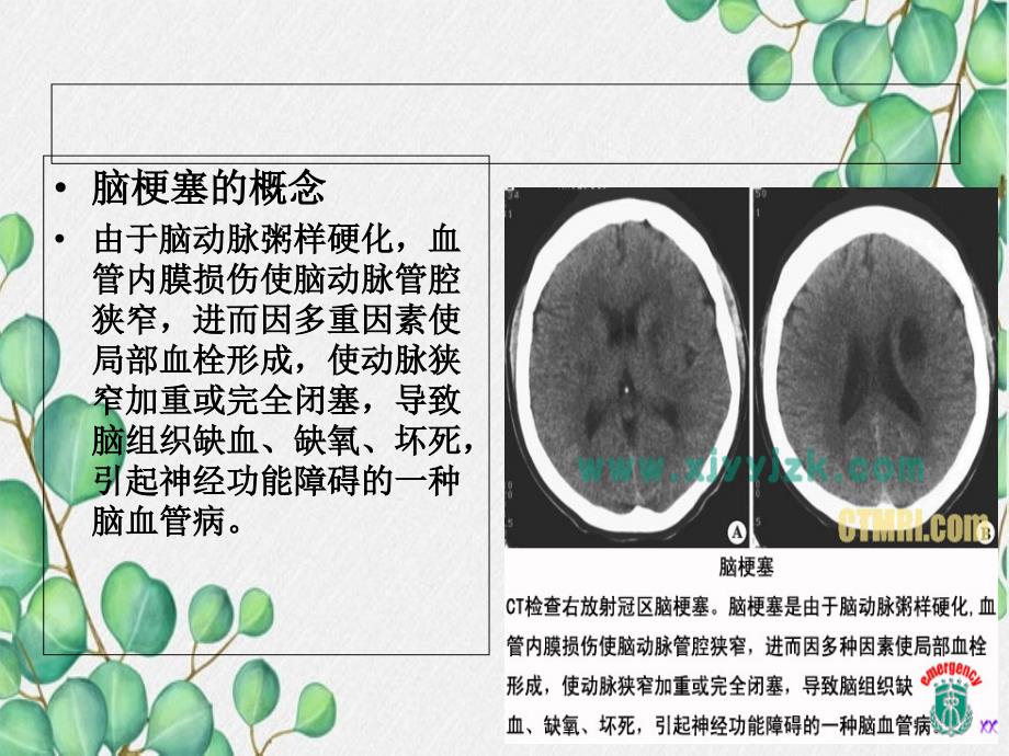 脑梗塞患者护理教学查房_第4页