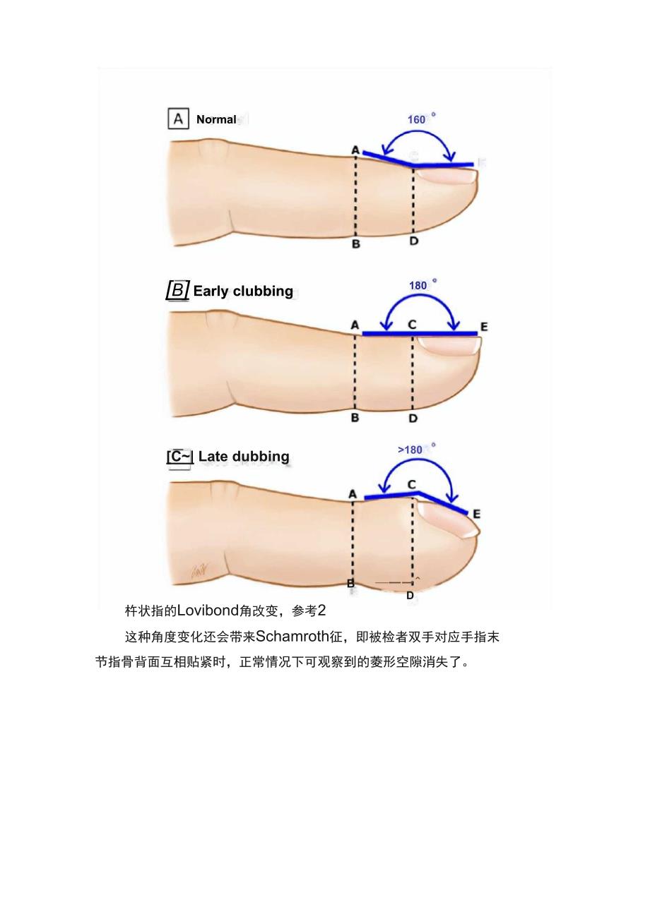 杵状指与肥大性骨关节病_第2页