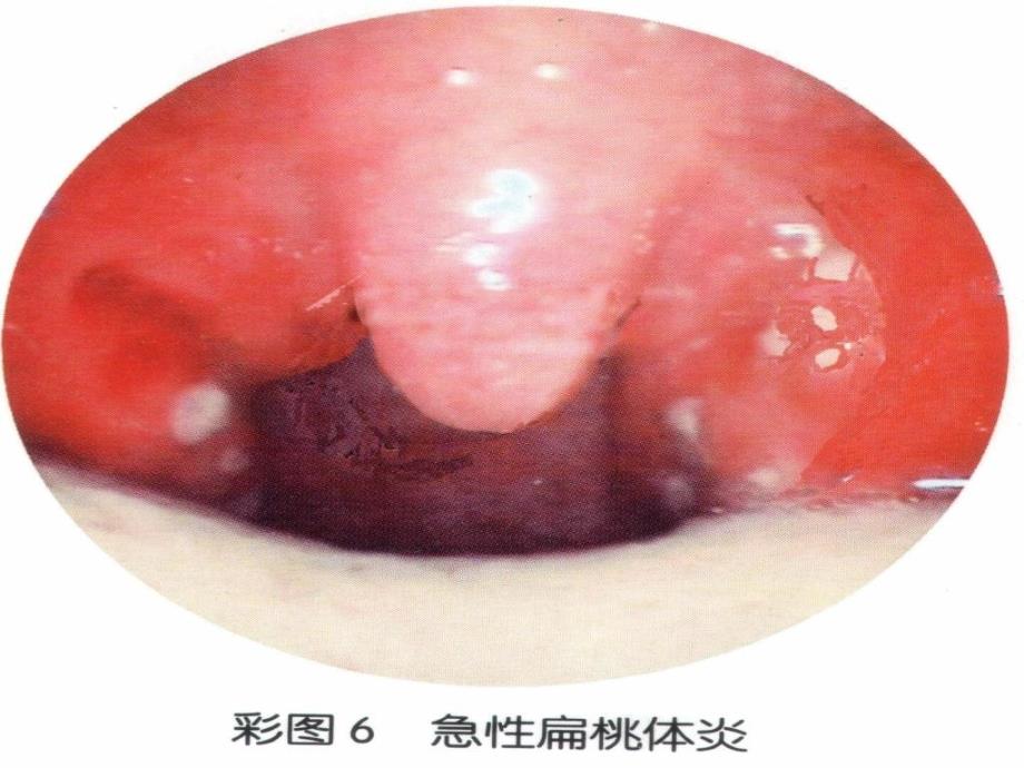 扁桃体炎病人的护理_第5页