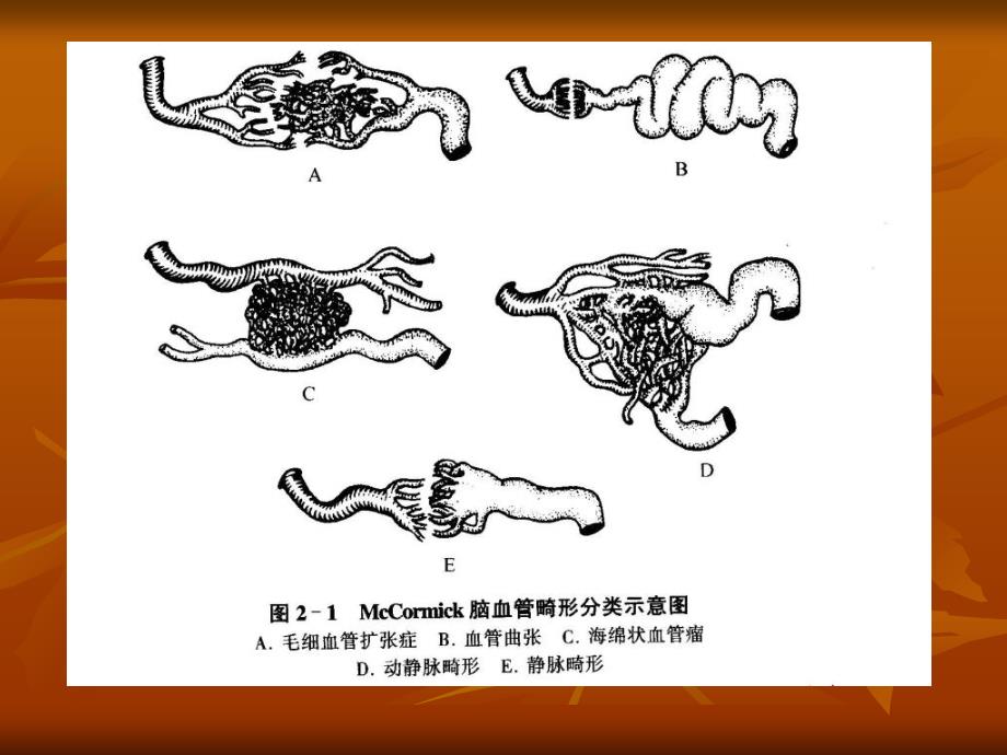 《脑血管畸形》PPT课件_第4页