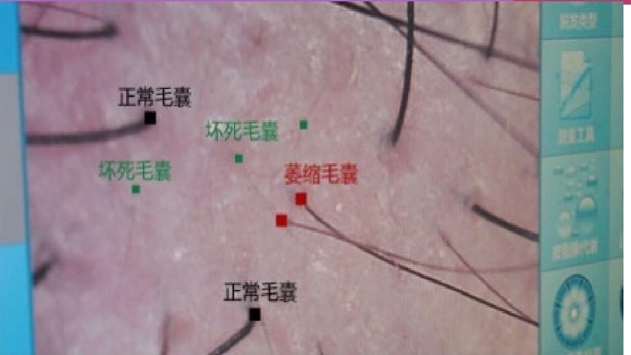 推荐精选植发基础知识_第5页