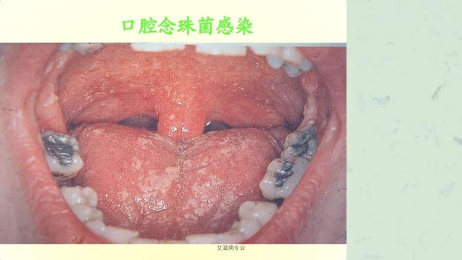 艾滋病专业课件_第2页