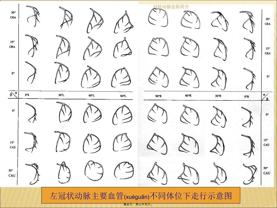 冠状动脉造影简介课件_第5页