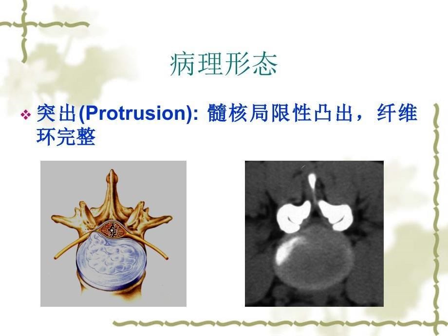 腰椎术并发症及护理文档资料_第5页