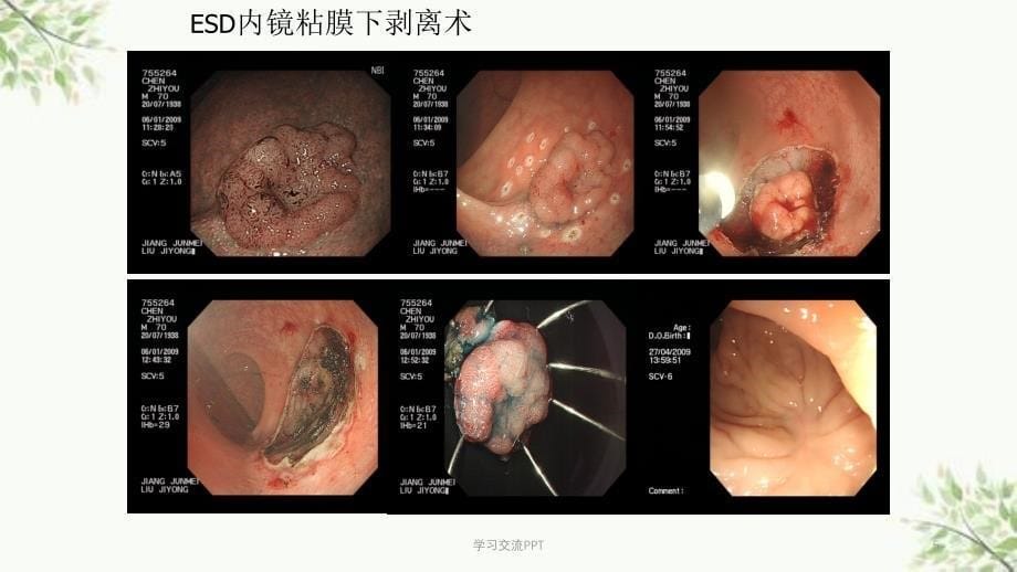 消化内镜治疗新技术ppt课件_第5页