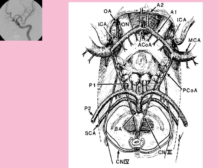 前交通动脉瘤解剖与临床ppt课件_第4页