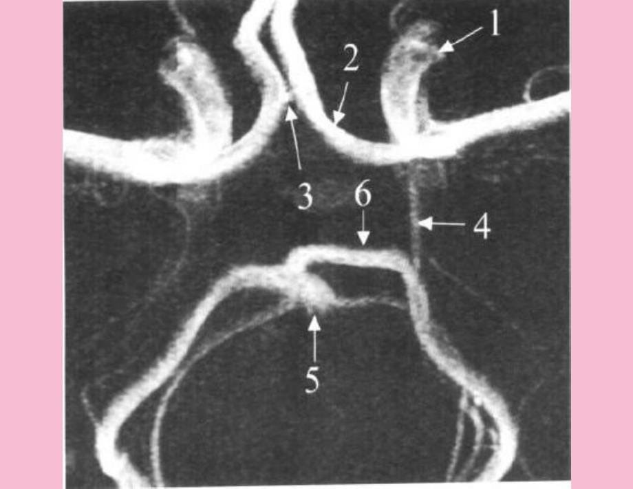 前交通动脉瘤解剖与临床ppt课件_第5页