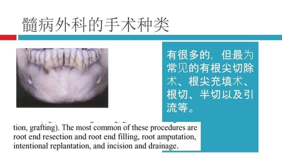 根尖手术的器械准备课件_第5页