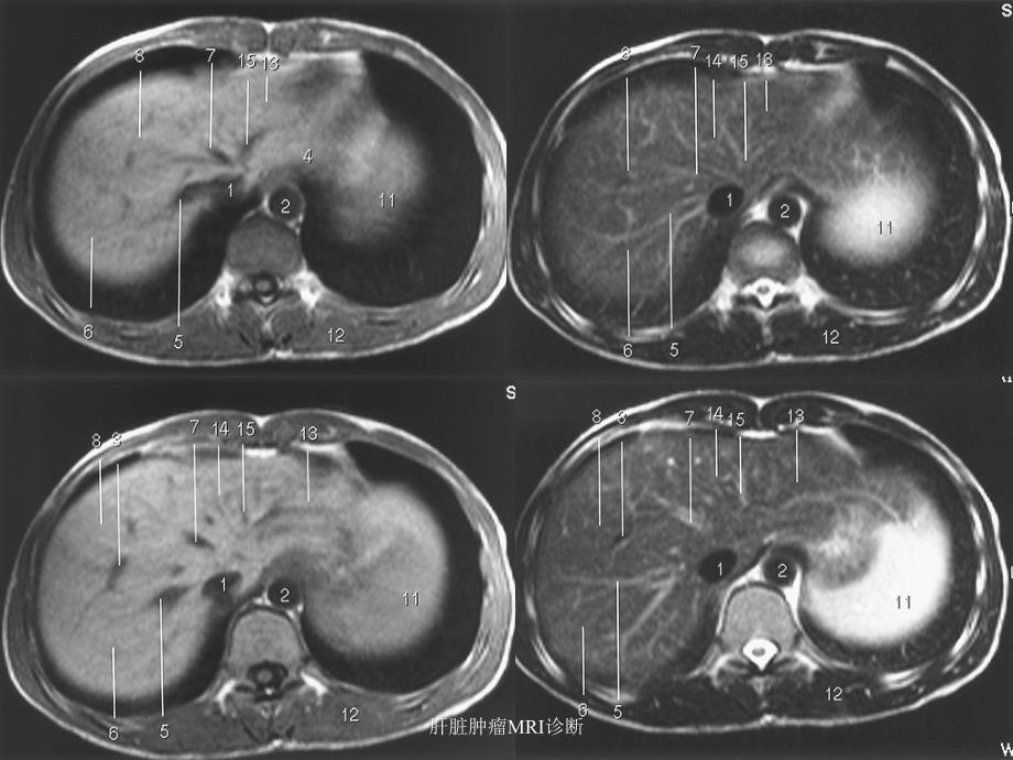 最新肝脏肿瘤MRI诊断_第4页