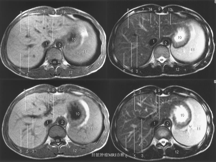最新肝脏肿瘤MRI诊断_第5页