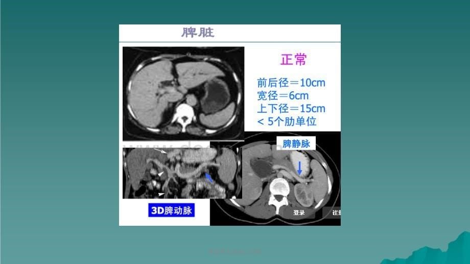 脾脏常见疾病CT诊断课件_第5页