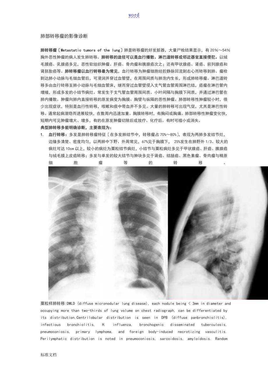 肺部转移瘤地影像诊断_第1页