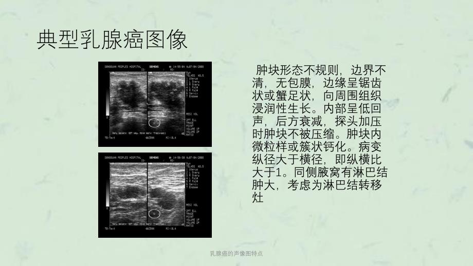 乳腺癌的声像图特点课件_第3页