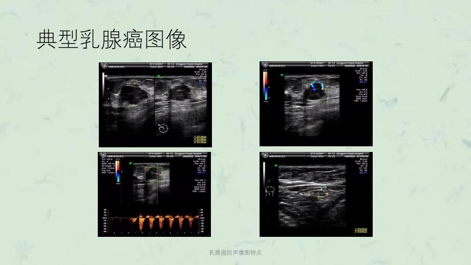 乳腺癌的声像图特点课件_第4页