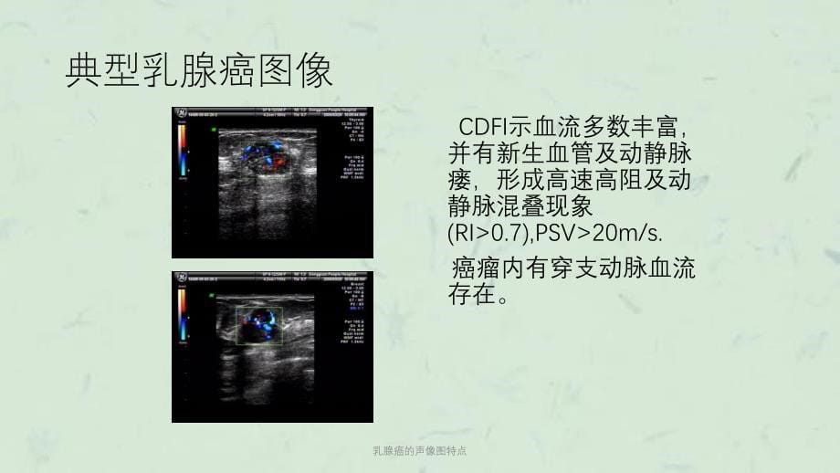 乳腺癌的声像图特点课件_第5页