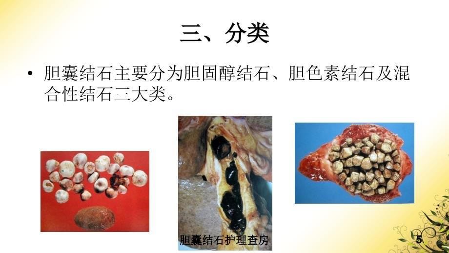 胆囊结石护理查房培训课件_第5页