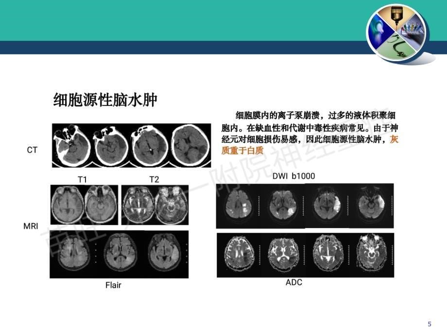 颅内高压与脑水肿的机制及治疗 PPT课件.ppt_第5页