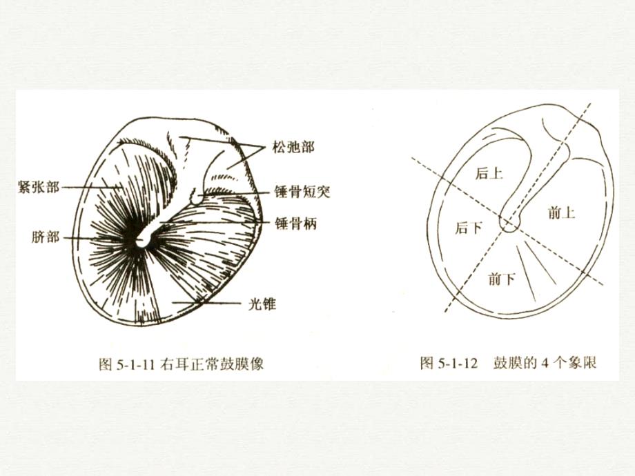 化脓性中耳炎及其并发症新_第3页