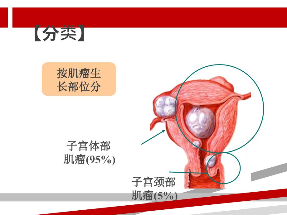 子宫肌瘤护理课件_第2页