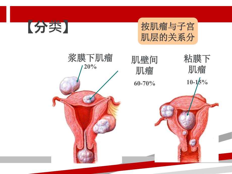 子宫肌瘤护理课件_第3页