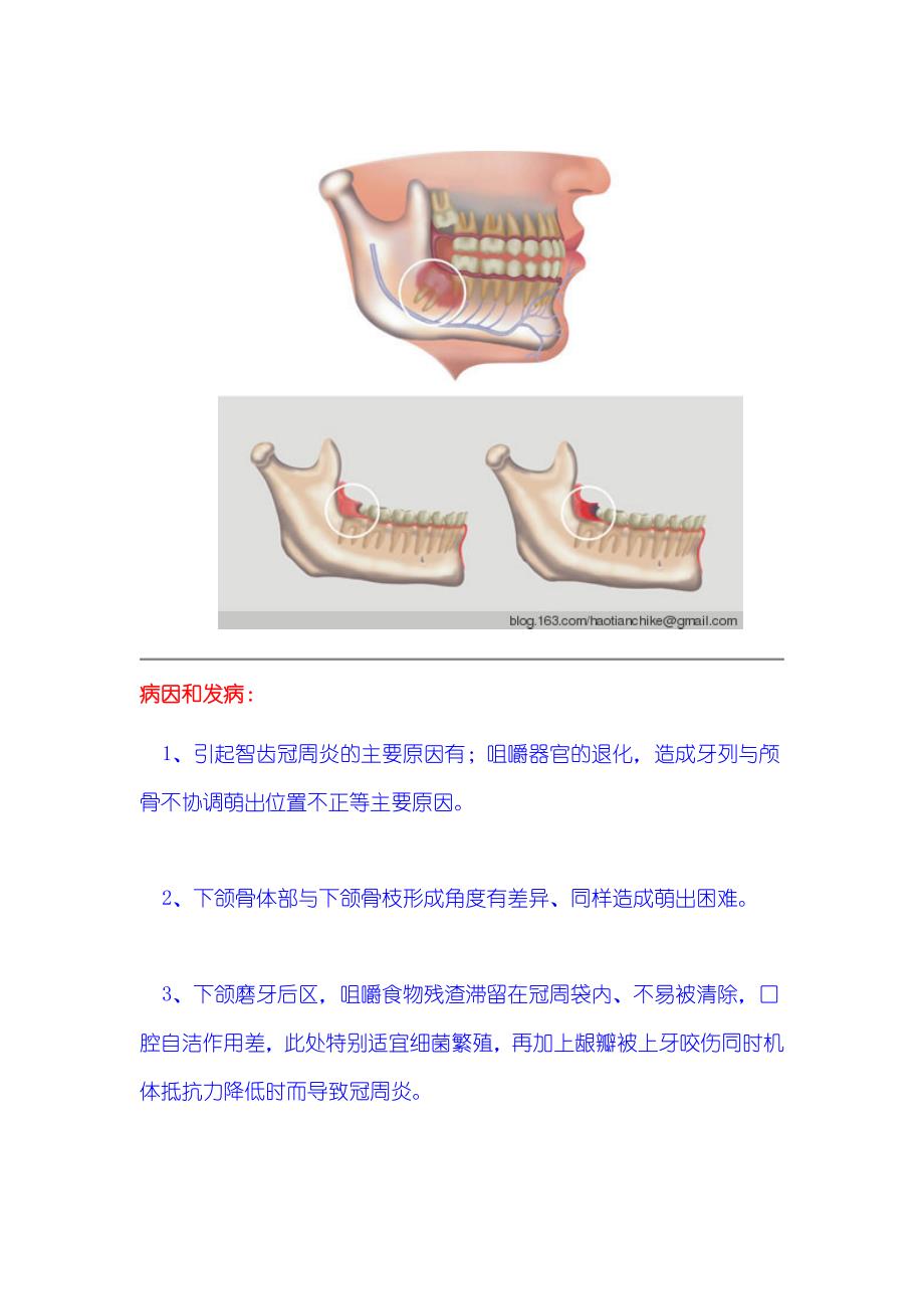 长智齿疼怎么办.doc_第2页