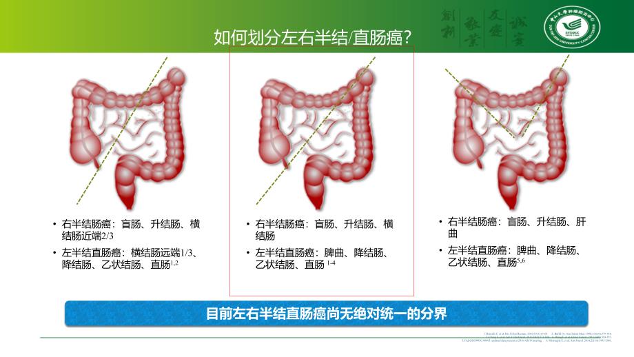 左右半结直肠癌的区别课件_第3页