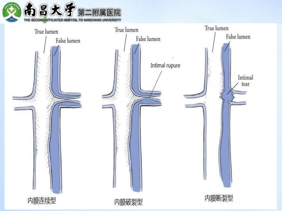 累及内脏动脉的B型主动脉夹层的处理.ppt_第4页