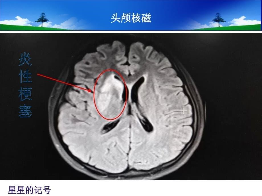 结核性脑膜炎护理查房.ppt_第5页