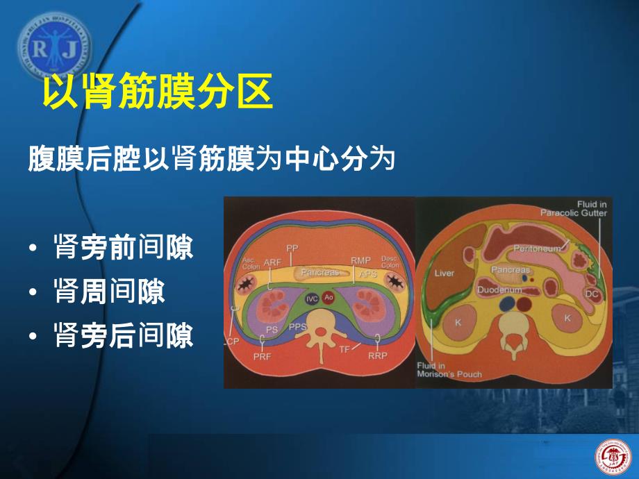 腹膜后病变和淋巴瘤的诊断及活检陈克敏ppt课件_第3页