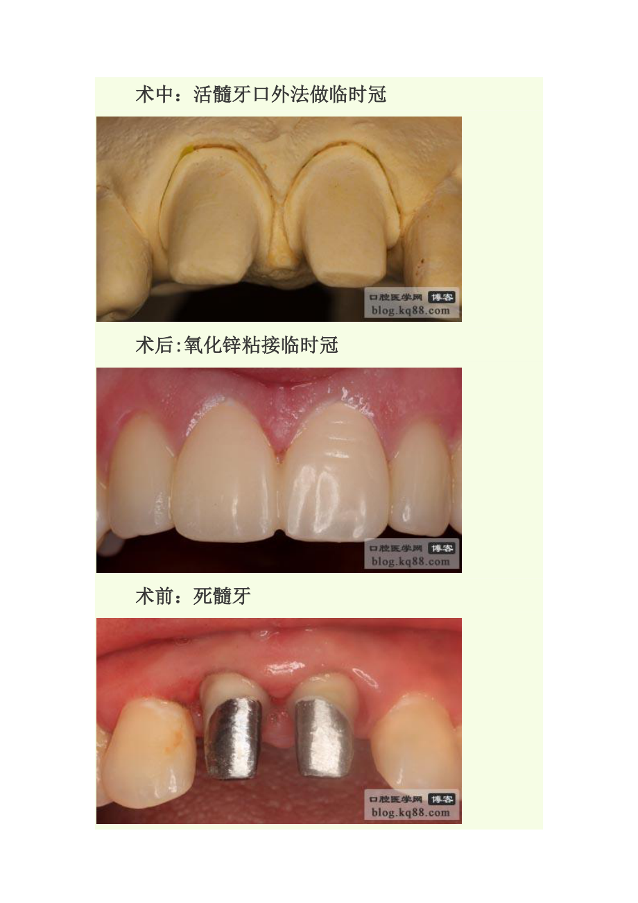 临时冠的制作方法与临床应用_第2页