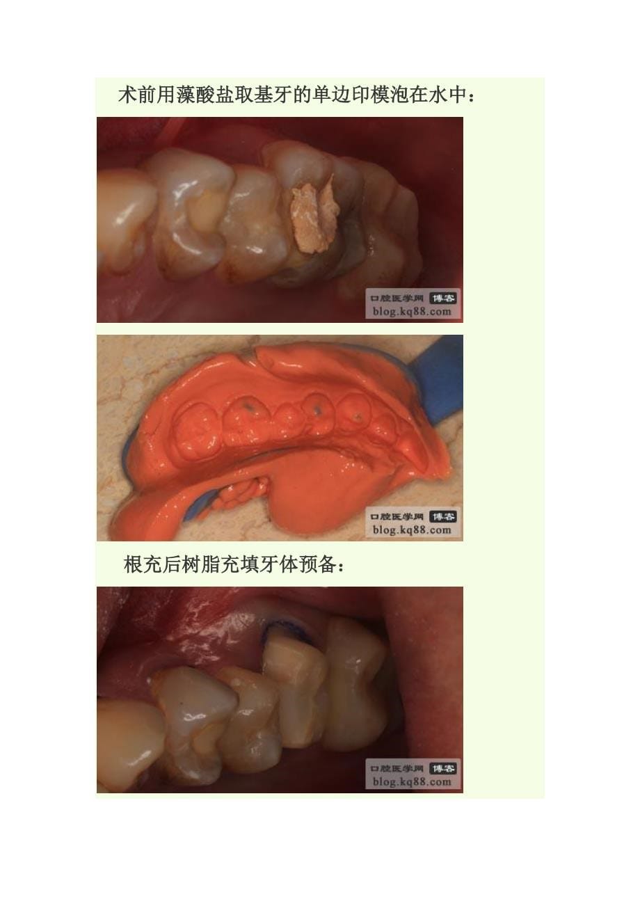 临时冠的制作方法与临床应用_第5页