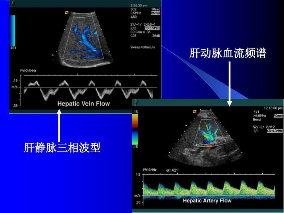 腹部常见病的超声诊断_第5页