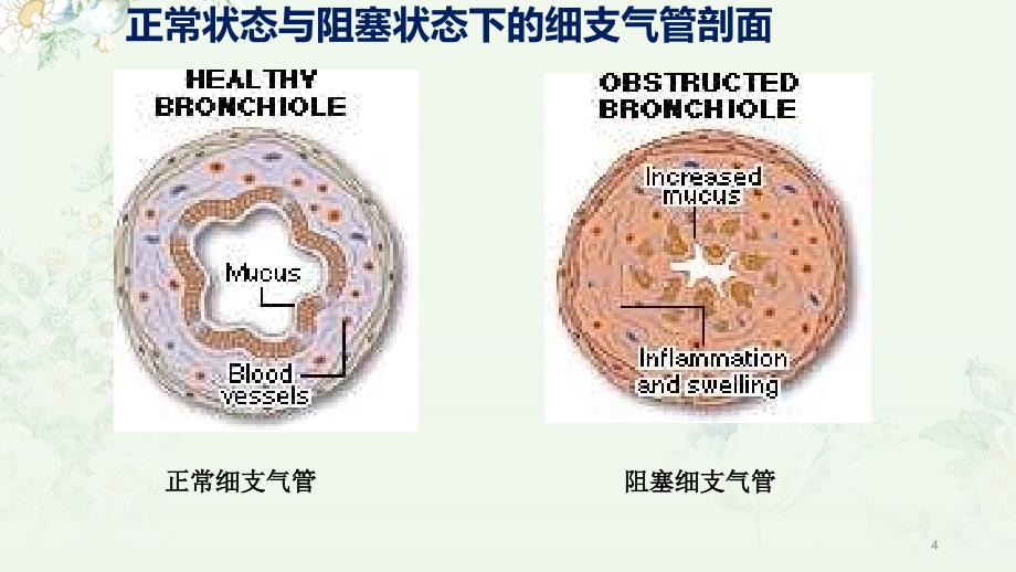 哮喘健康教育PPT演示课件_第4页