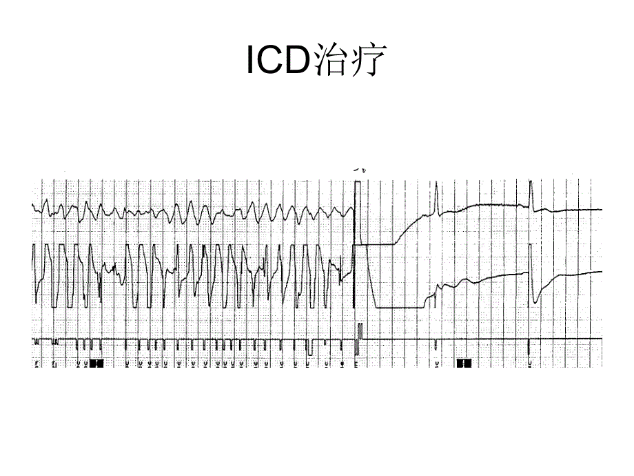 ICD术后抗心律失常药物的应用_第4页