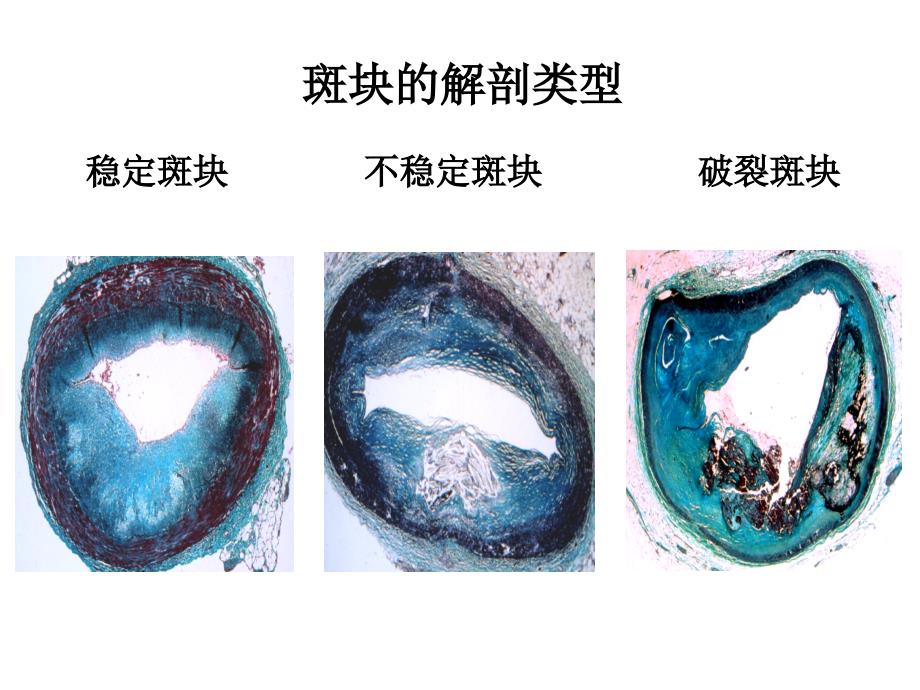 动脉硬化PPT医学课件_第4页