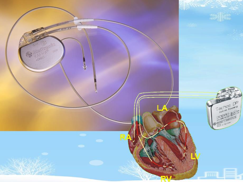 心脏起搏器2021完整版课件_第2页
