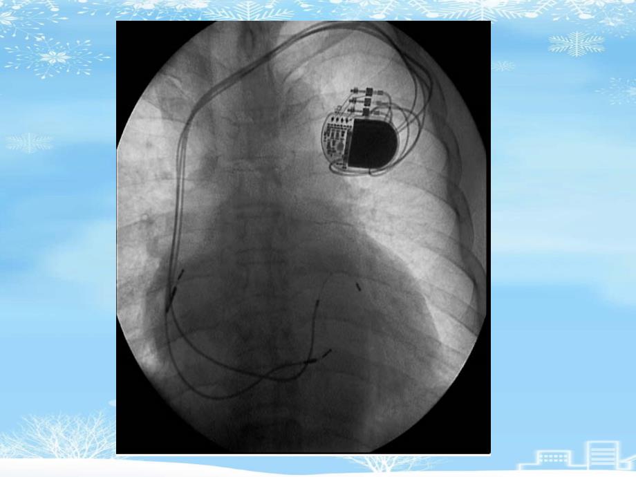 心脏起搏器2021完整版课件_第3页