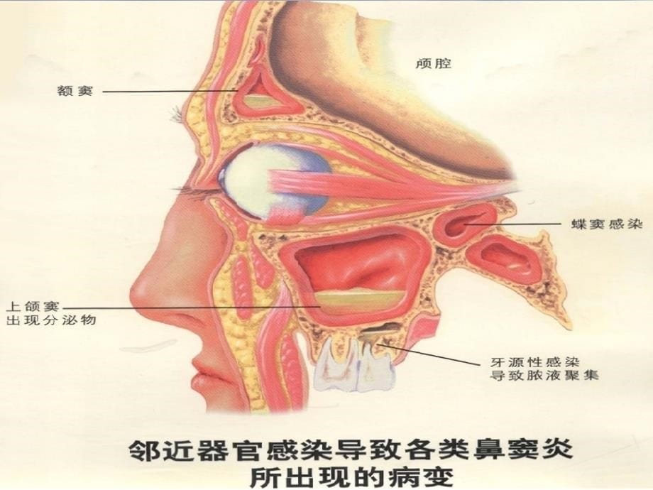 鼻窦炎的分类及护理_第5页