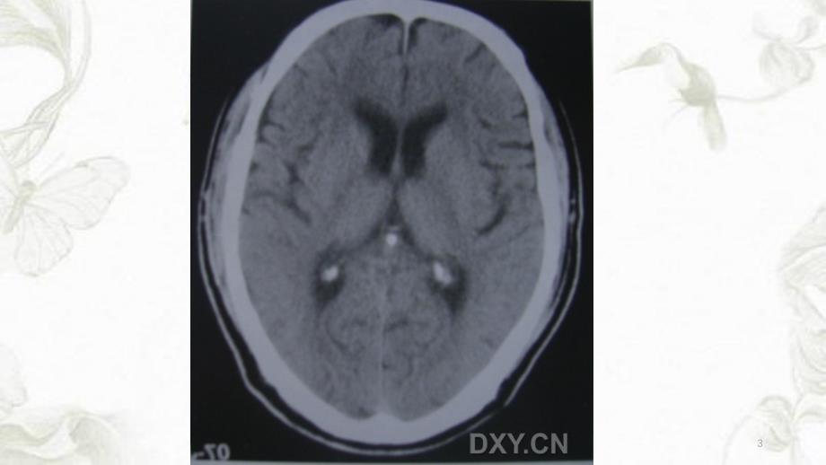 脑部钙化的CT诊断干货分享_第3页