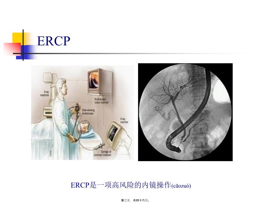 医学专题一ERCP围手术期处理_第2页