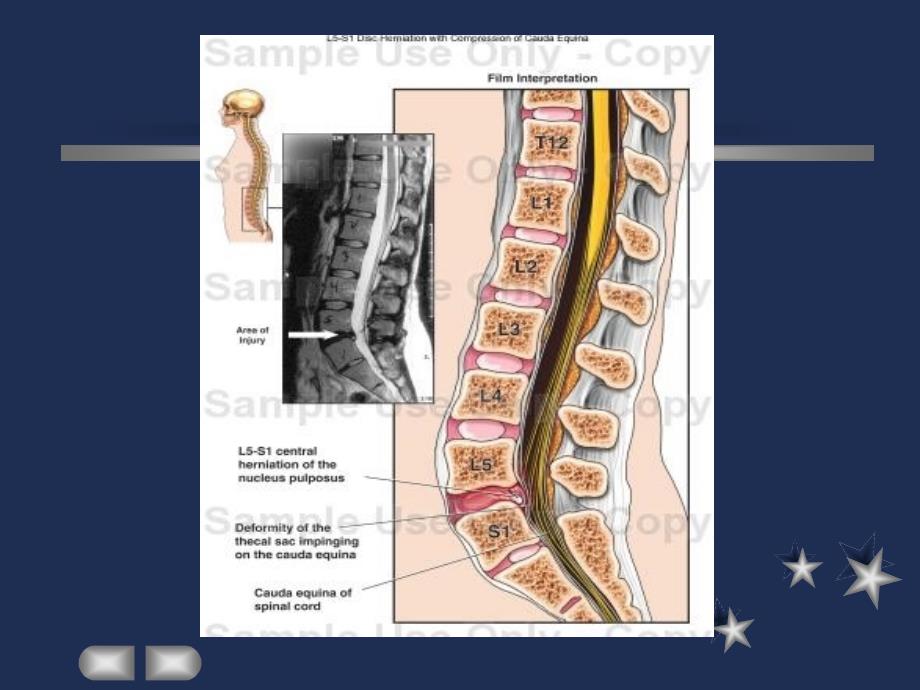 外科学教学课件：腰椎间盘突出症_第2页