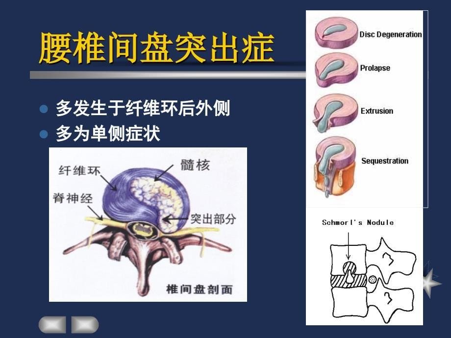 外科学教学课件：腰椎间盘突出症_第5页