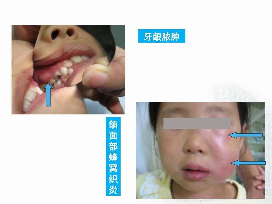 儿童牙髓病和根尖周病-精品医学课件ppt_第4页