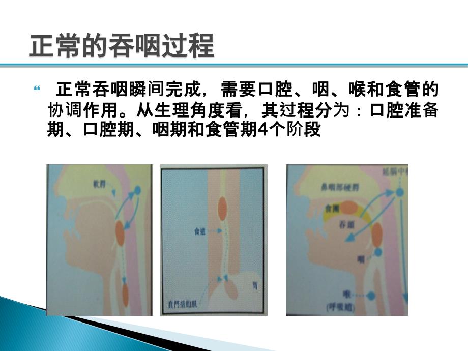 吞咽障碍患者的饮食管理课件_第4页