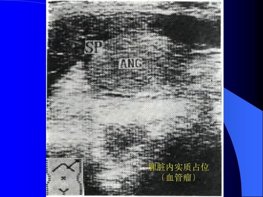 胰脾及胃肠道疾病超声诊断_第5页