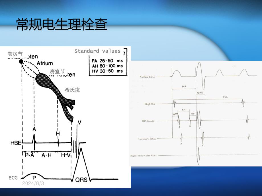 射频消融术及其护理1课件_第3页